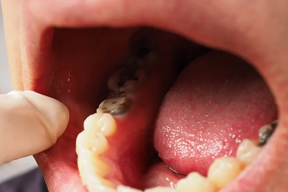 Root Canal Pain After a Root Canal