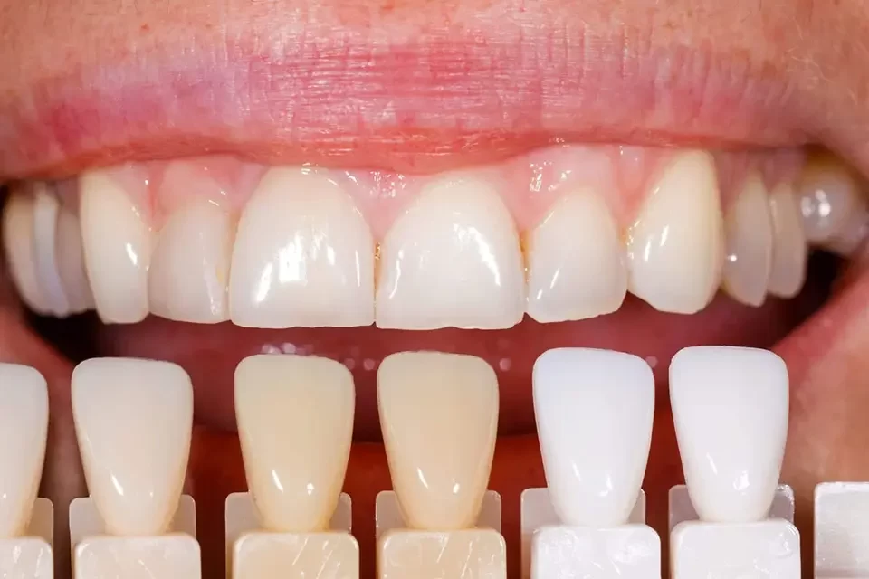 Bonded Teeth Whitening