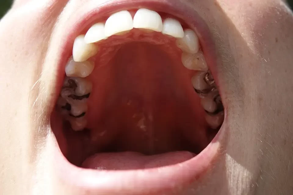 Old Fillings Old Fillings