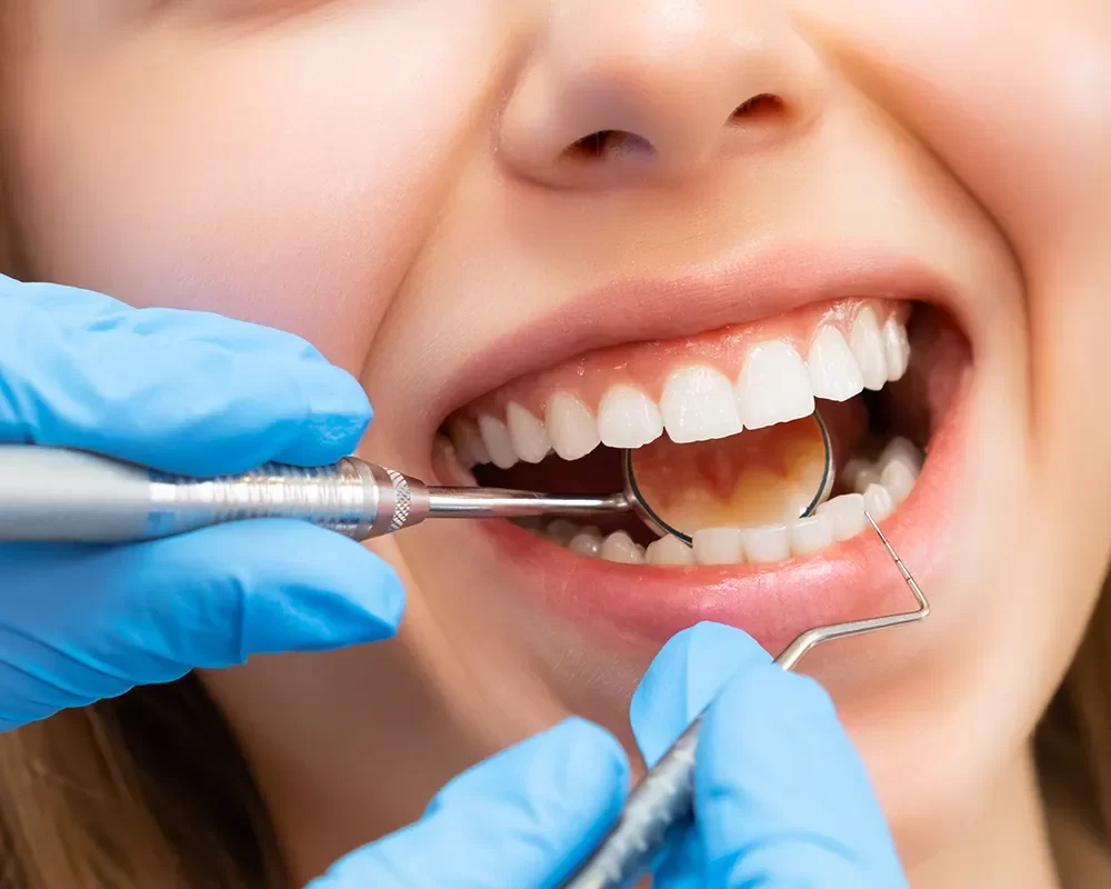 Canadian Dental Care Plan