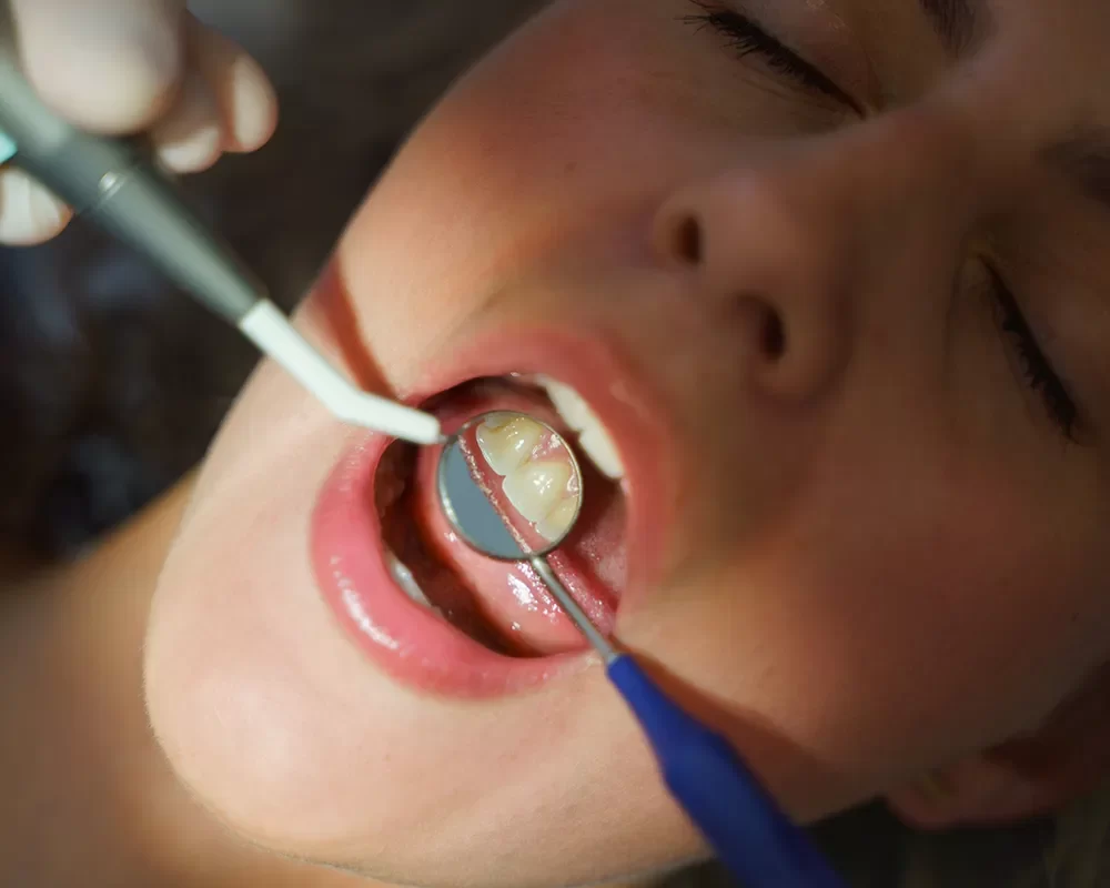 Canadian Dental Care Plan