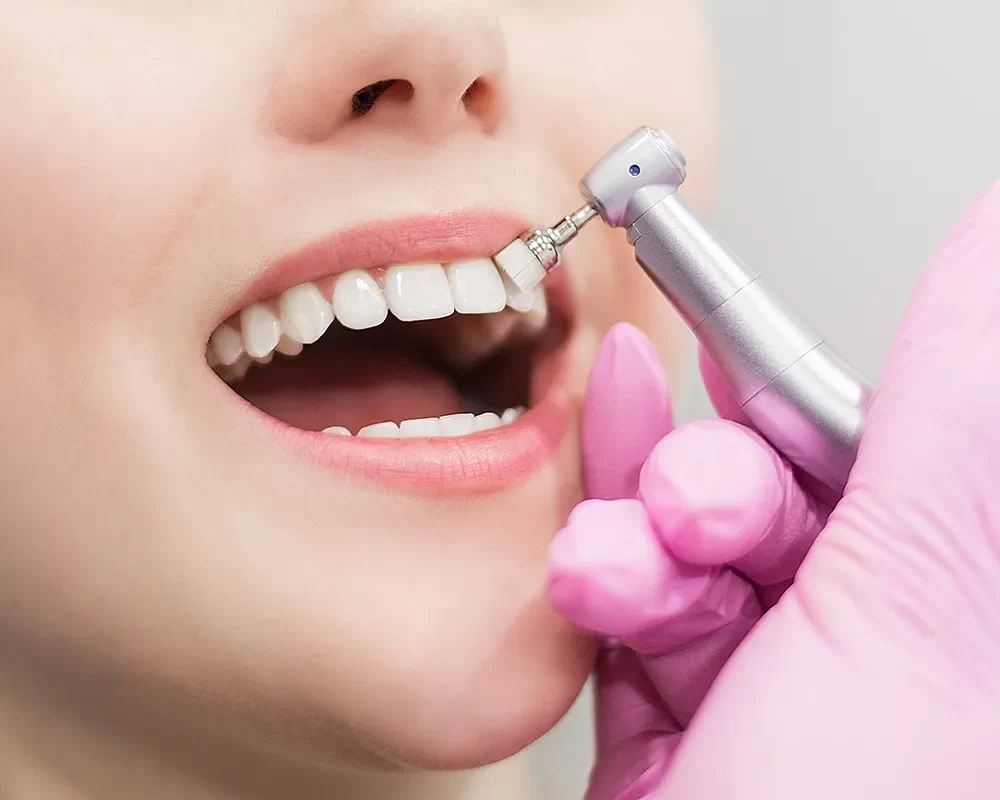 Dental Cleaning A dentist performing dental cleaning using a dental tool at Dental Cleaning in St. Clair