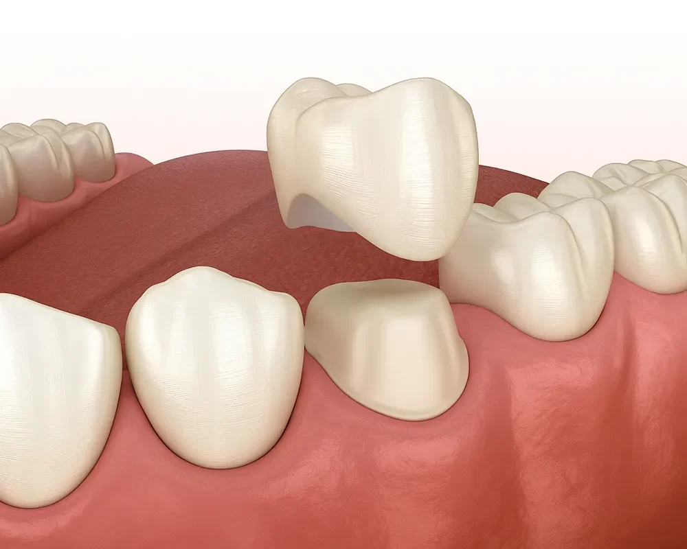 Best Dental Crowns in St. Clair, Toronto