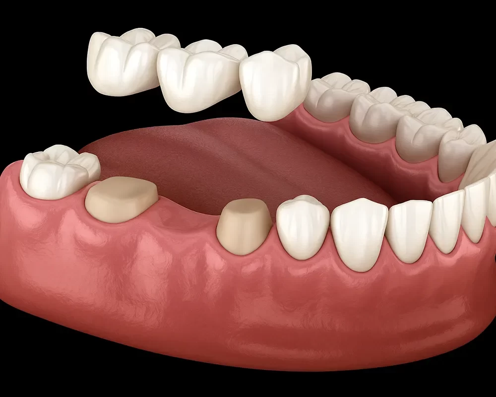 Dental Crowns and Bridges in Toronto