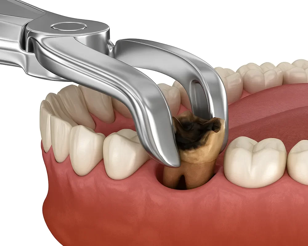 Best Dental Removal in St. Clair, Toronto