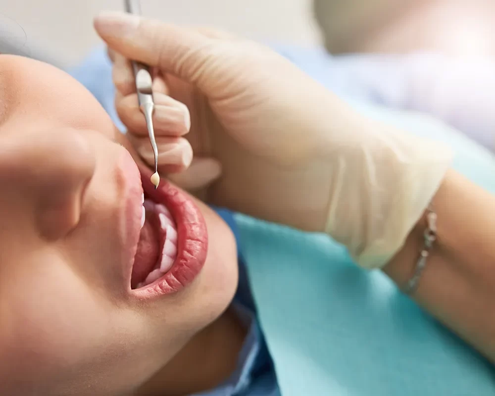 Best Dental Fillings in St. Clair, Toronto