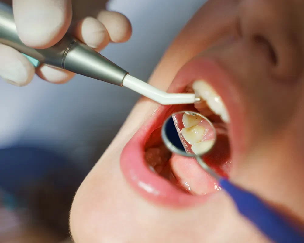 Perfect Dental Implants in St. Clair, Toronto