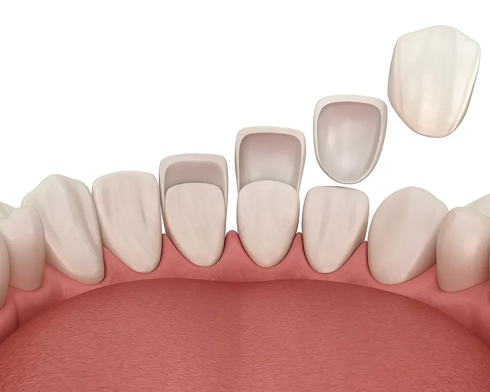 Perfect Dental Veneers in St. Clair, Toronto