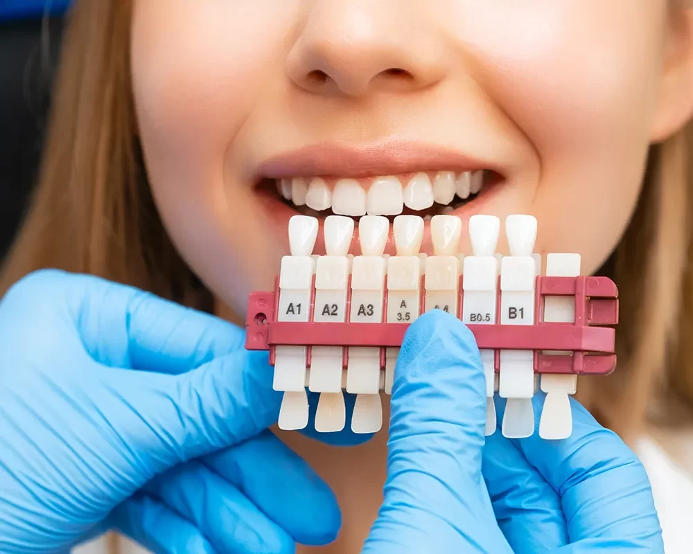 Affordable Dental Veneers in St. Clair, Toronto