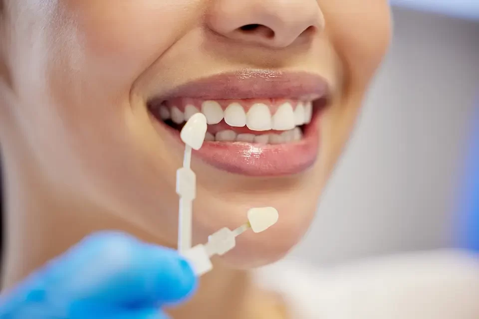 Dental Veneers How Long Do Veneers and Composite Bonding Last?