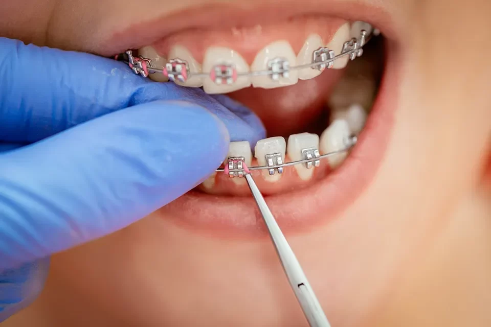 Tooth Extraction and Orthodontics Tooth Extraction and Orthodontics