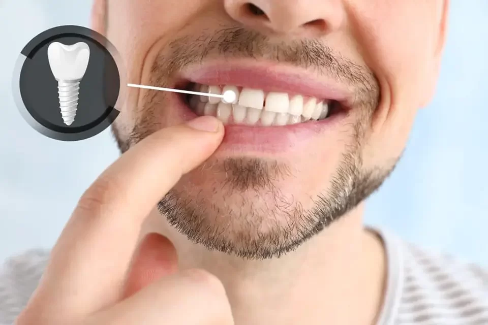 Dental Implants Success Rate of Dental Implants
