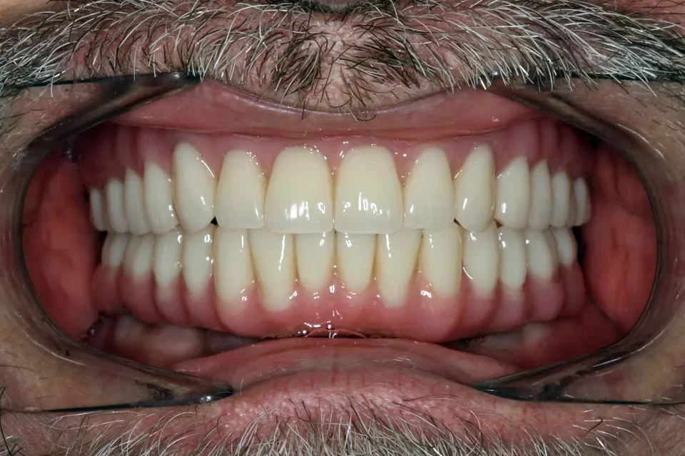 Dental Health Full Mouth Implants