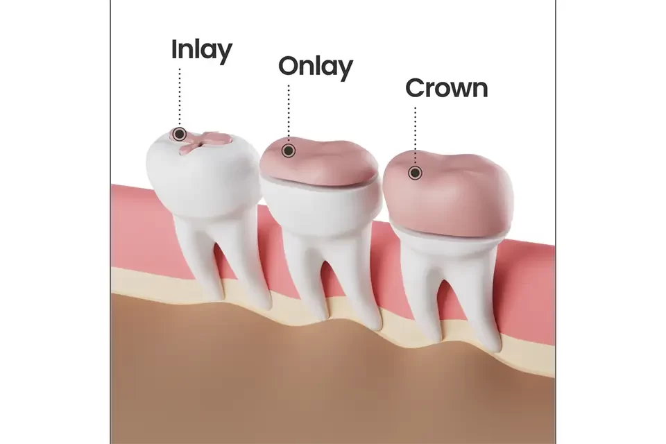 Dental Crown Alternatives Dental Crown Alternatives