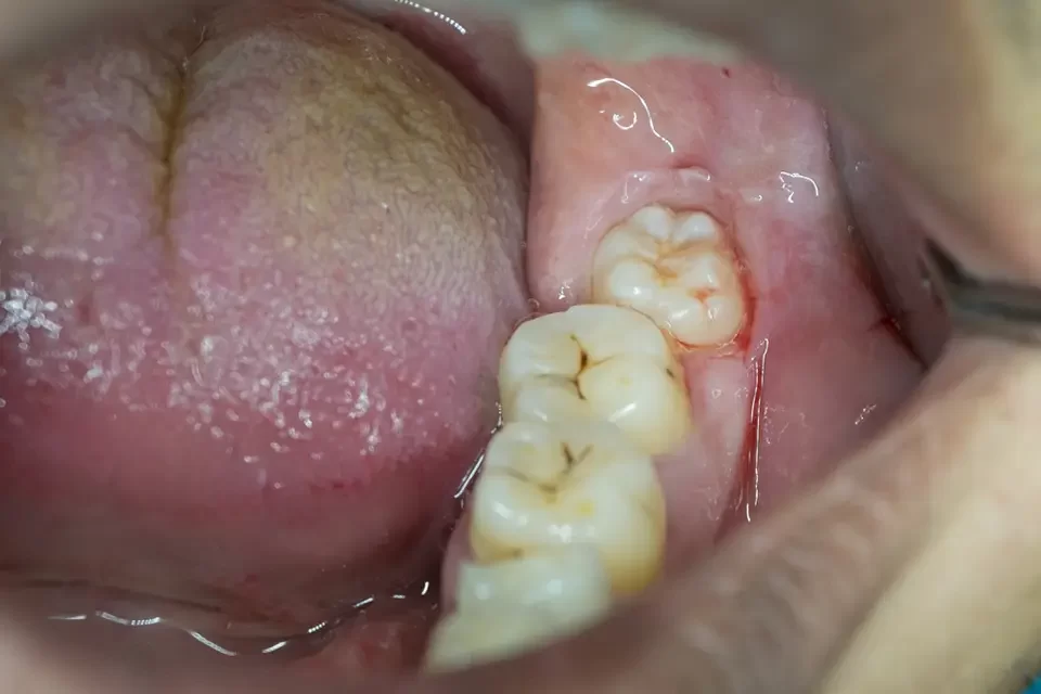 Impacted Wisdom Teeth Why Impacted Wisdom Teeth Need Attention