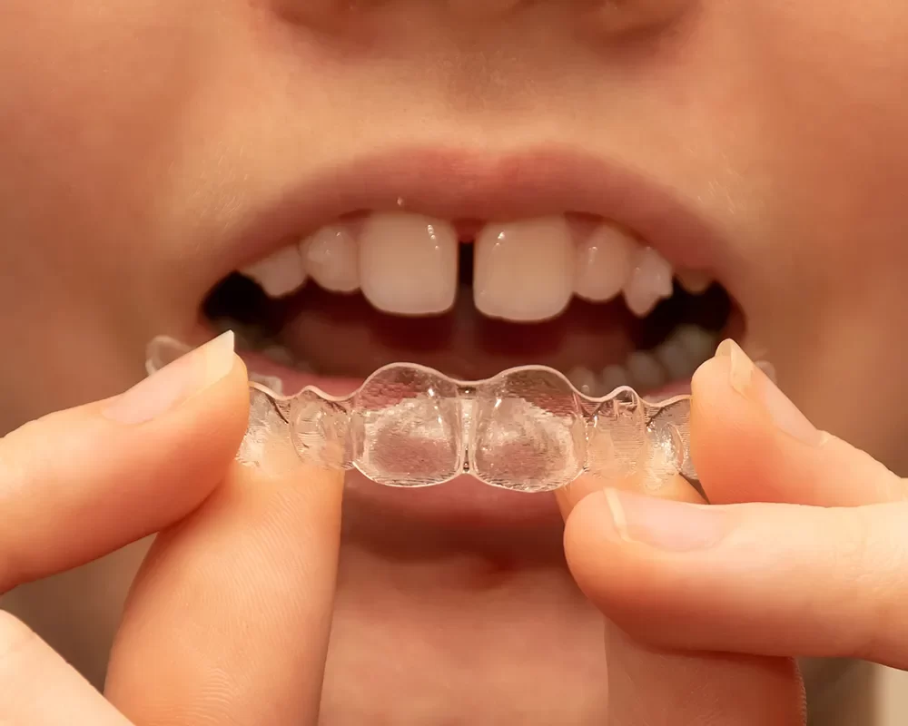 Affordable Invisalign® in St. Clair, Toronto