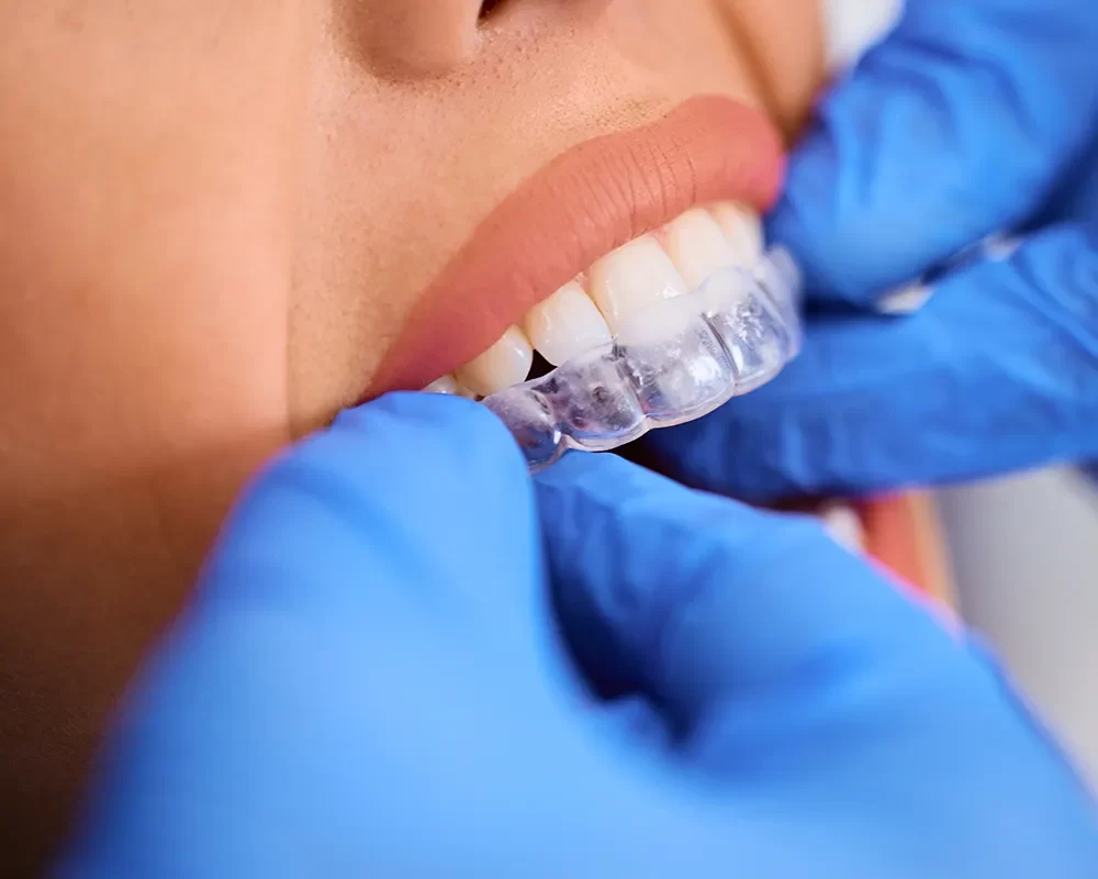 Affordable Clear Aligners in Toronto