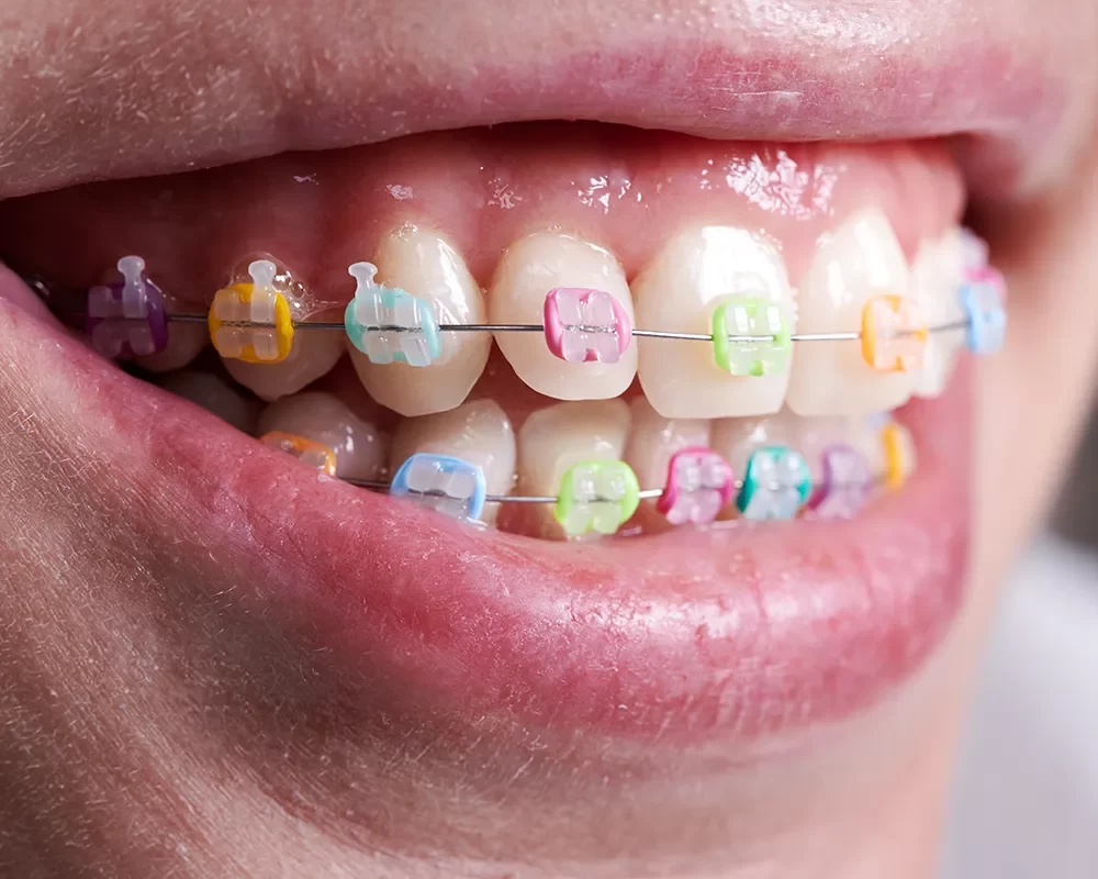 Best Braces in Toronto