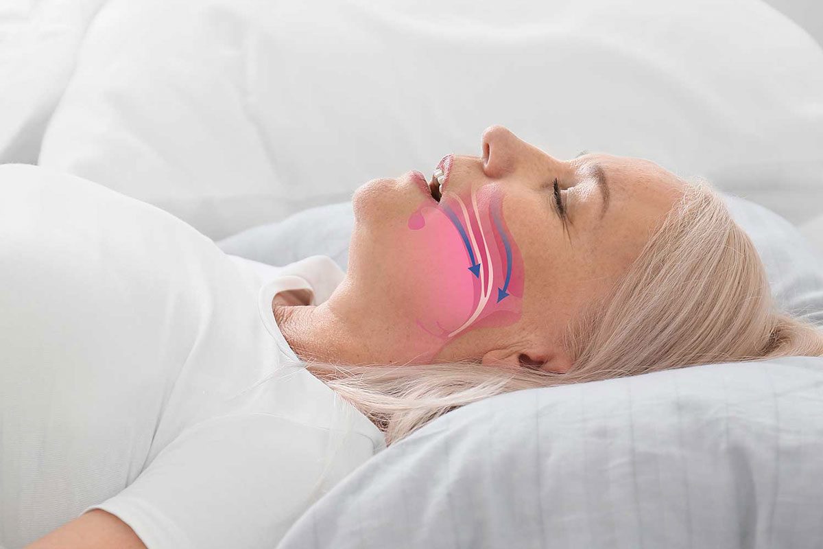 Sleep Apnea Advantages of Using Mouth guards to Treat Sleep Apnea By Smile Dental in Toronto