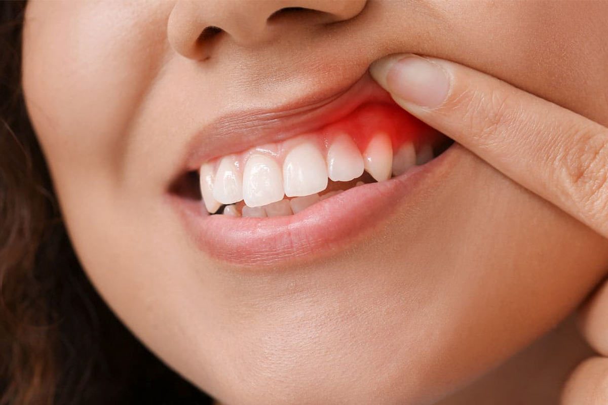 Periodontal Disease The Link Between Genetics and Dental Health