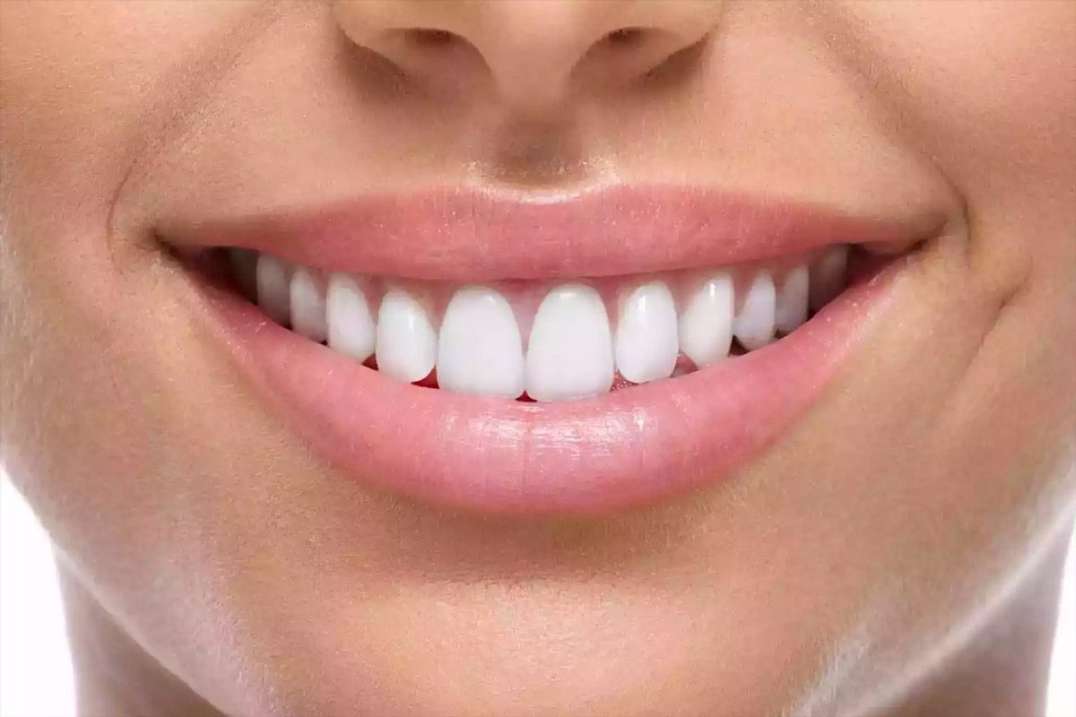 The Importance of a Beautiful Smile Porcelain Veneers vs. Composite Veneers