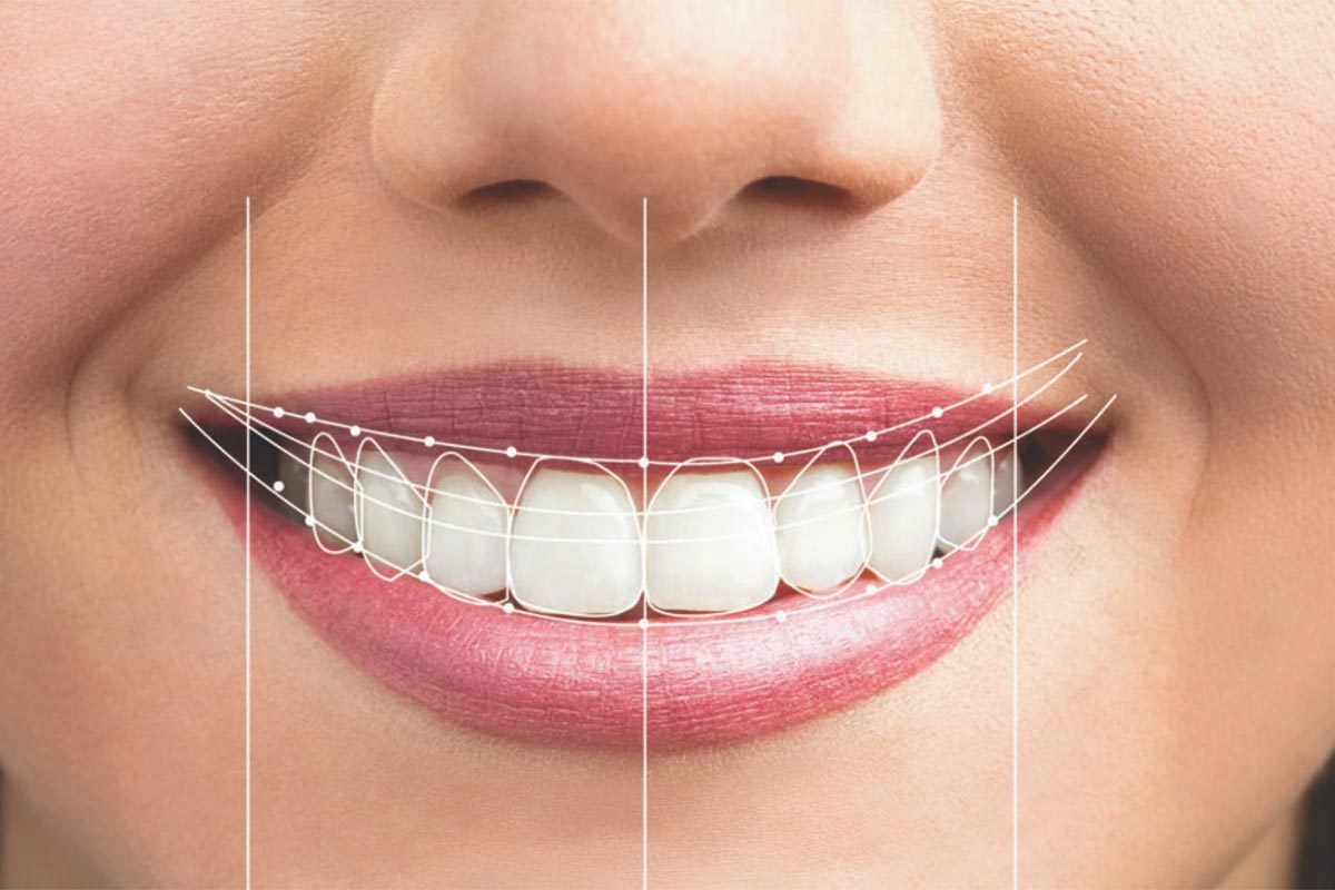 The Importance of a Beautiful Smile Choosing Colours And Shapes For Veneers And Crowns