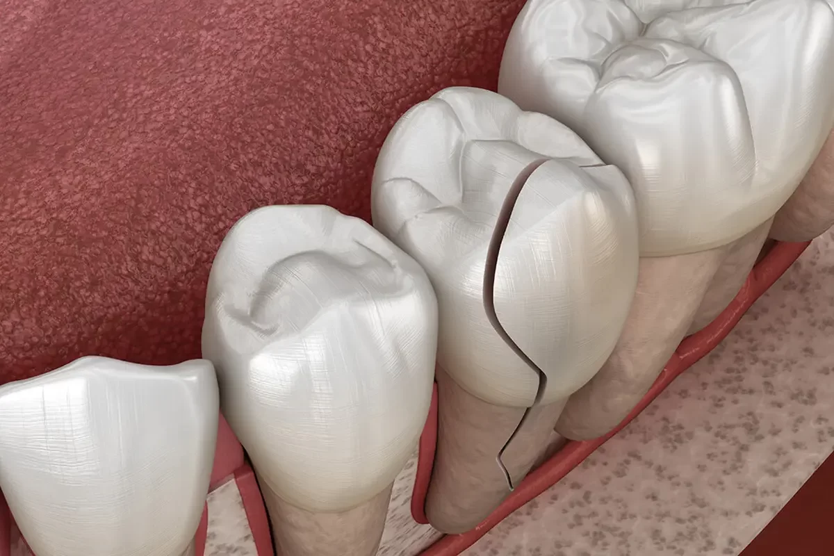 Dental Crowns When Do I Need A Dental Crown?