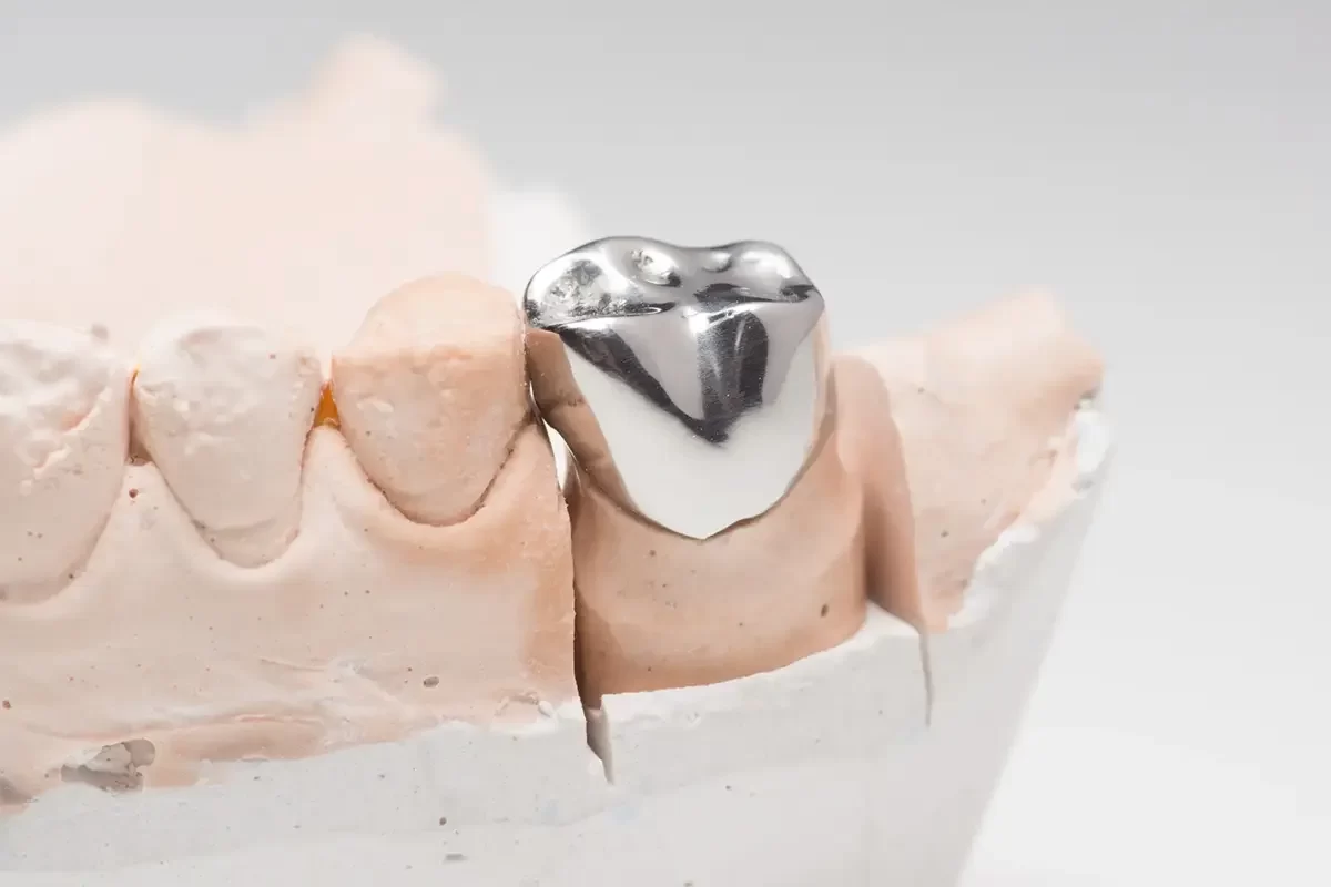 Dental Crowns Tips for Maintaining Whiter Dental Crowns