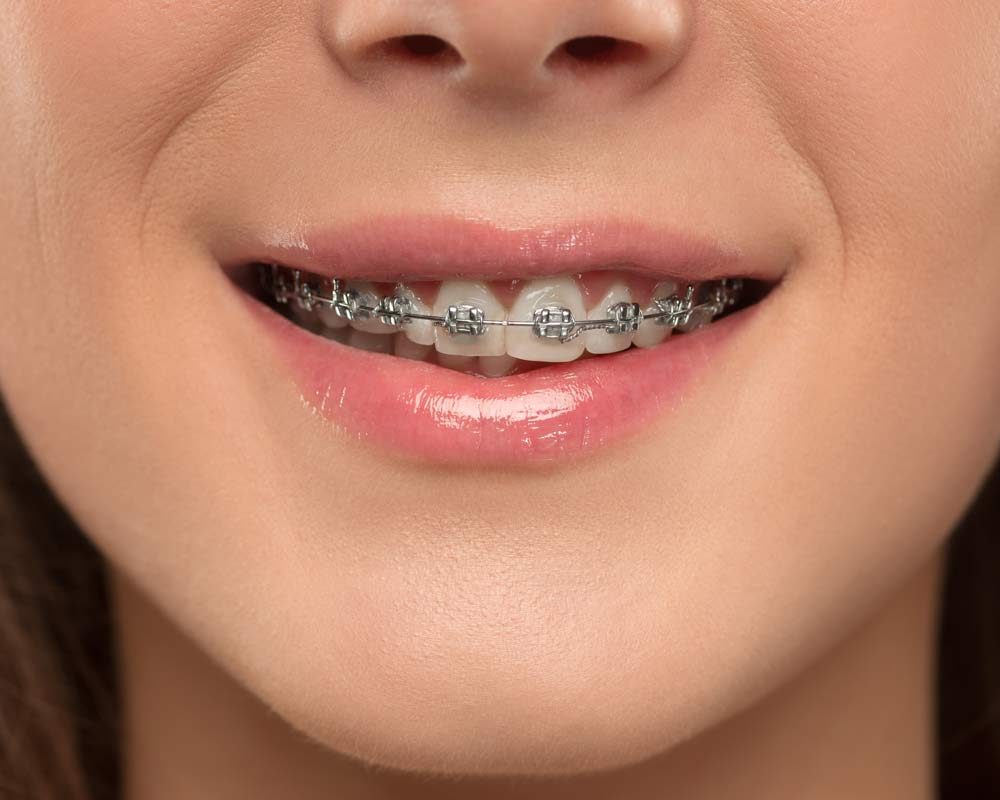 Affordable Orthodontics in St. Clair, Toronto