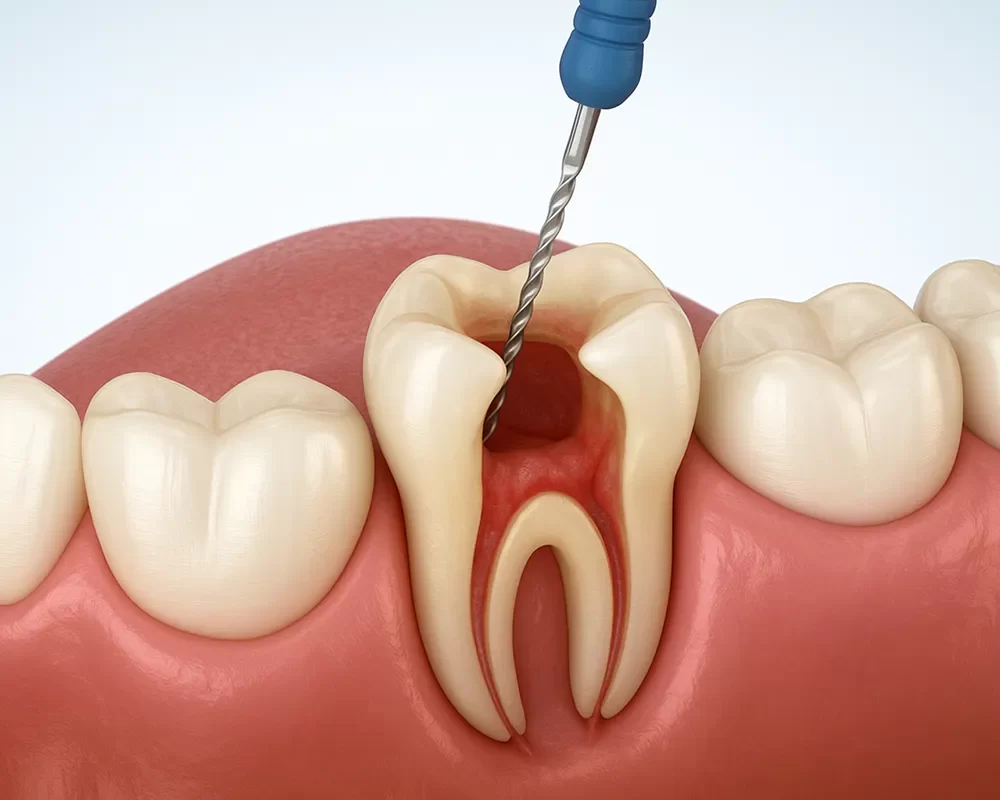 Best Endodontic Treatment in Toronto