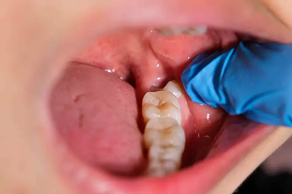 Impacted Wisdom Teeth Impacted Wisdom Teeth