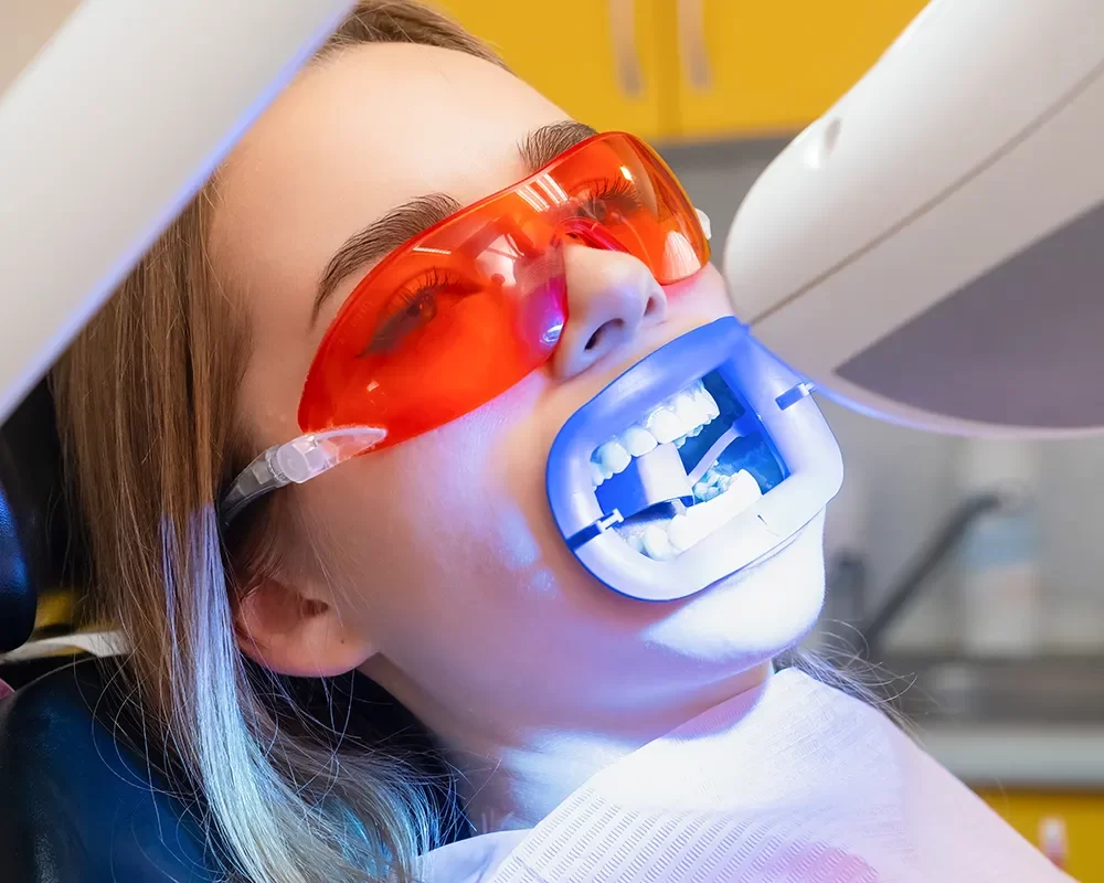 Perfect Teeth Whitening in St. Clair, Toronto