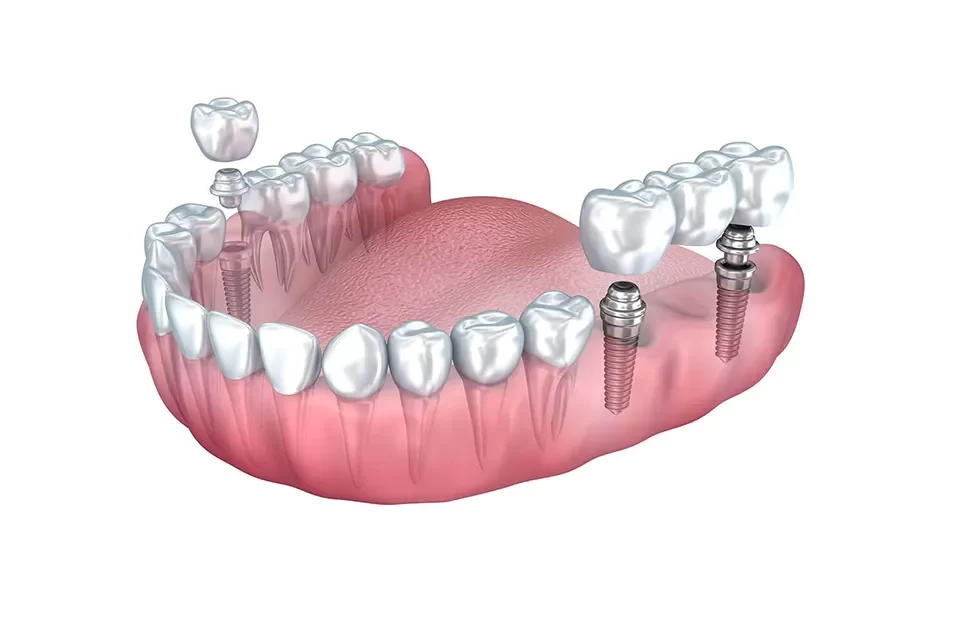Implant Bridges Single Tooth Implants