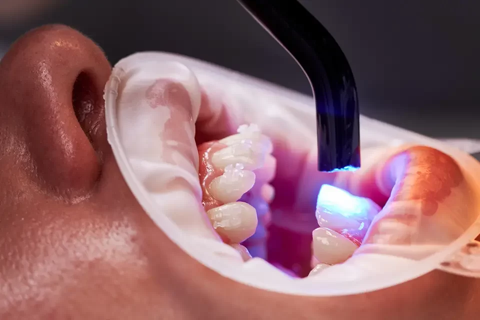Whitening treatment Factors That Affect Teeth Whitening Durability