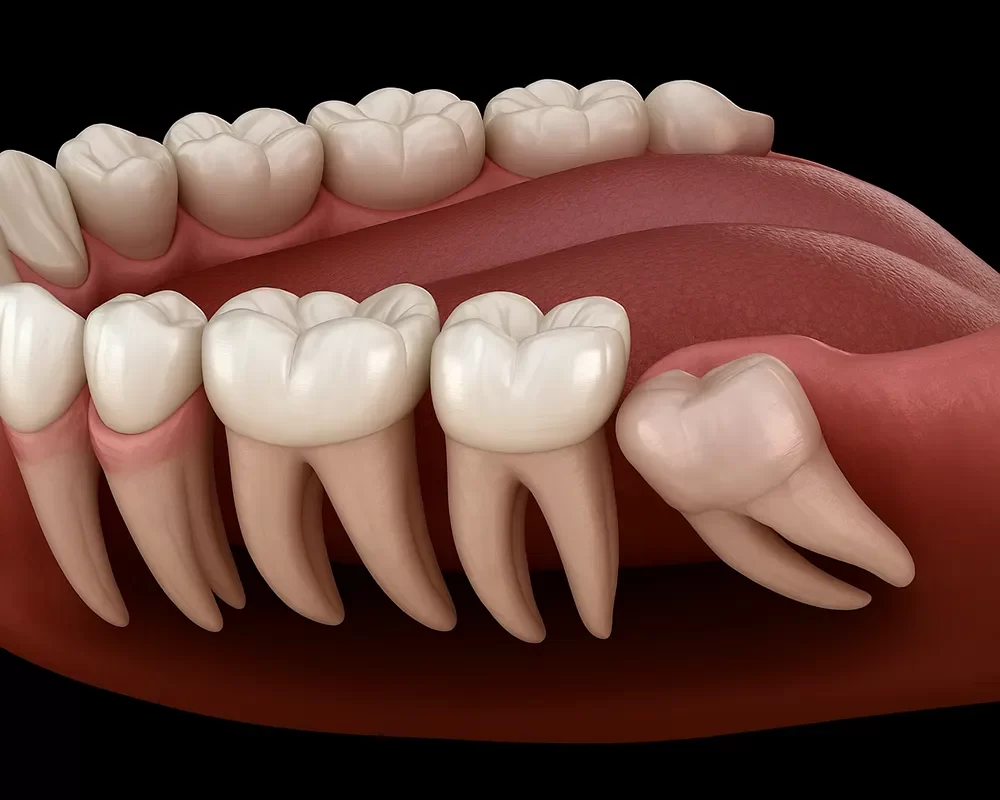 Affordable Wisdom Teeth Removal in St. Clair, Toronto