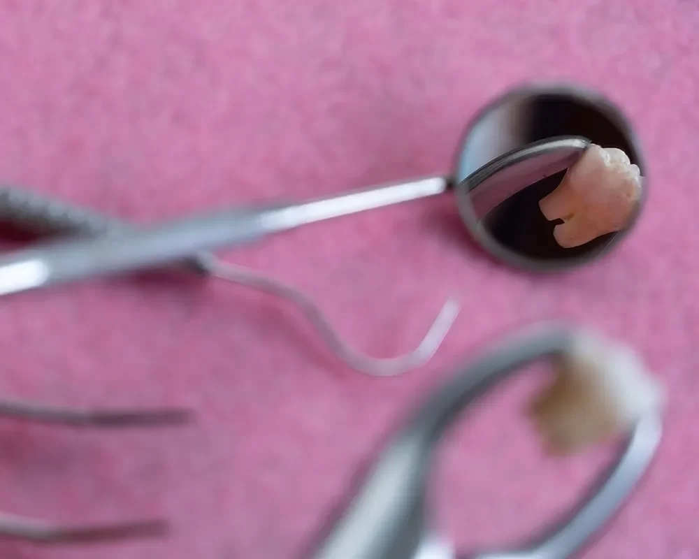 Perfect Tooth Extraction in Toronto