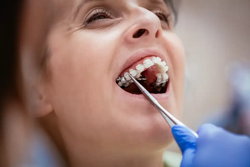 The Benefits of Orthodontics for Adults