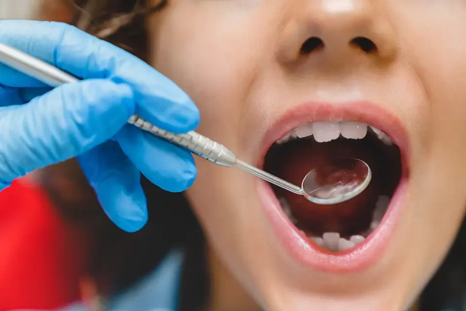 What Affordable Teeth Cleaning in Toronto Includes