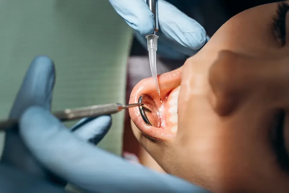 Preventing and Treating Dry Socket After Tooth Extraction in Toronto