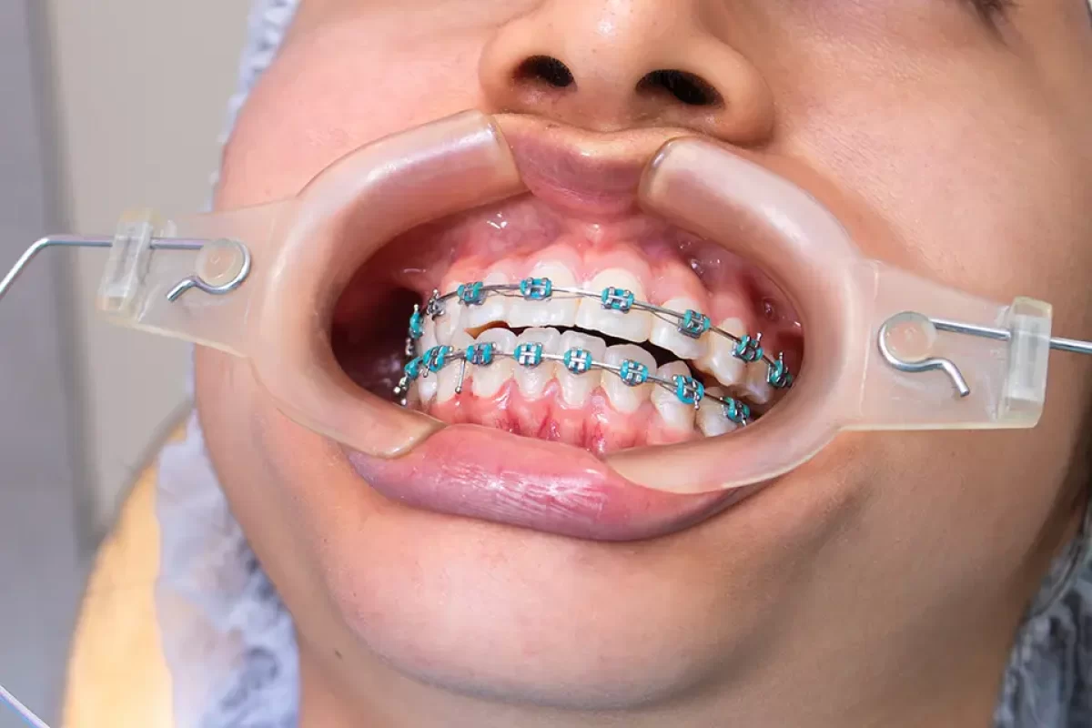 Braces