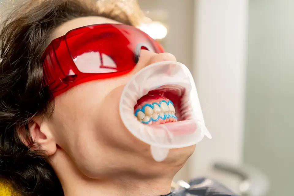 Zoom Teeth Whitening Toronto vs. Other Options