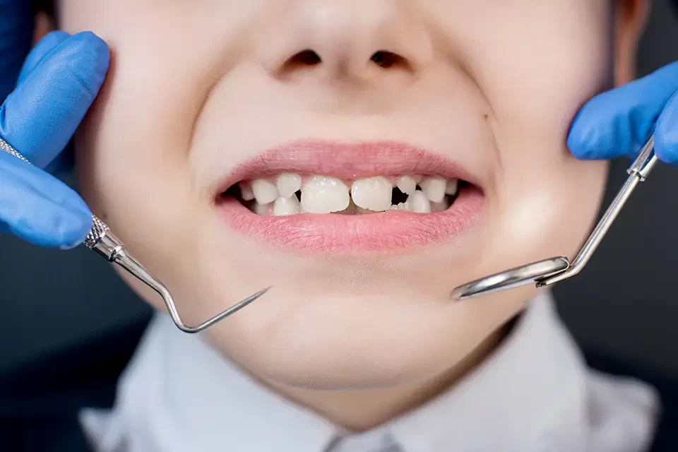 Dental Crowns for Children