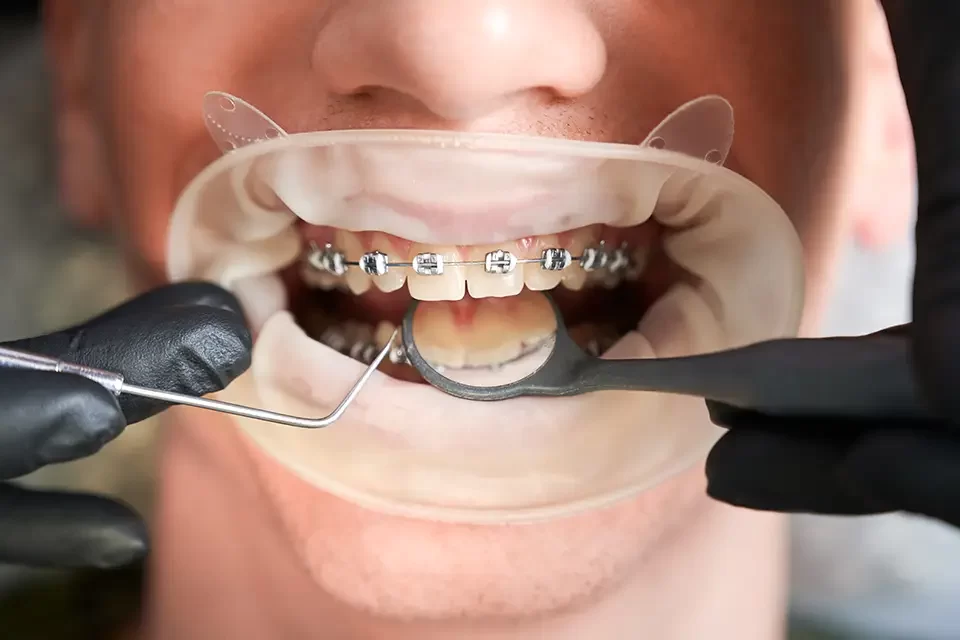 Right Time for Orthodontic Treatment