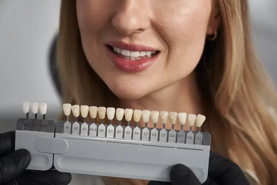 When to Choose Dental Veneers vs Crowns