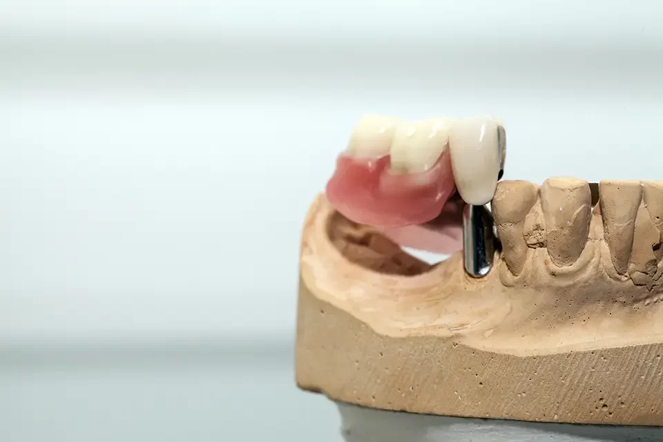 Single Tooth Implants